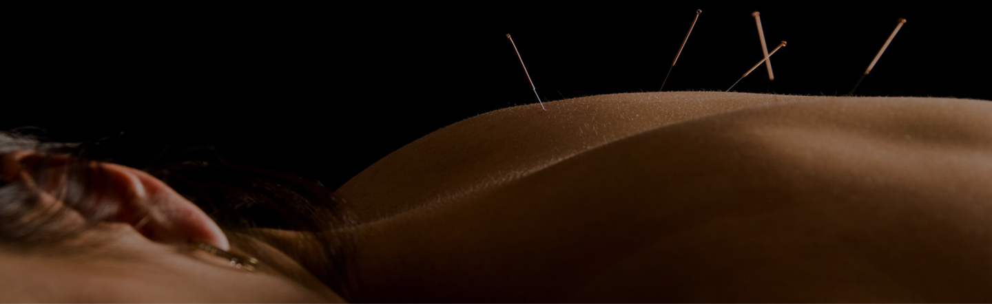 Acupuncture needles close up