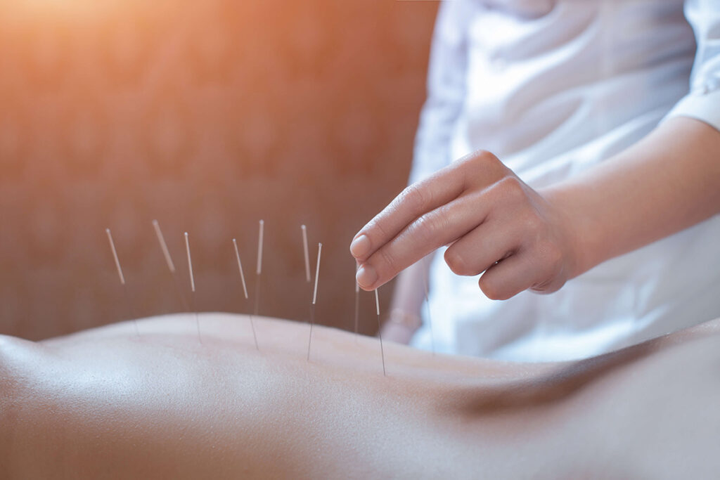 miscnceptions about acupuncture