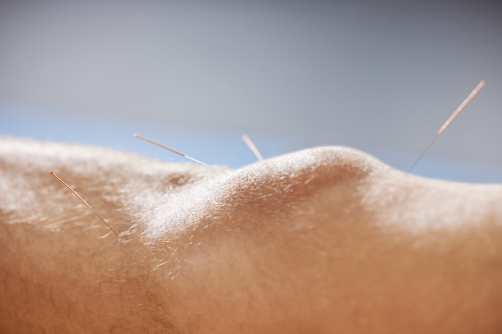 Acupuncture Needles in A Knee for Arthritis Treatment