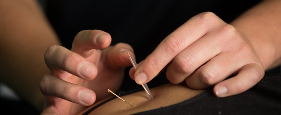 How Acupuncture is the Perfect Summertime Remedy