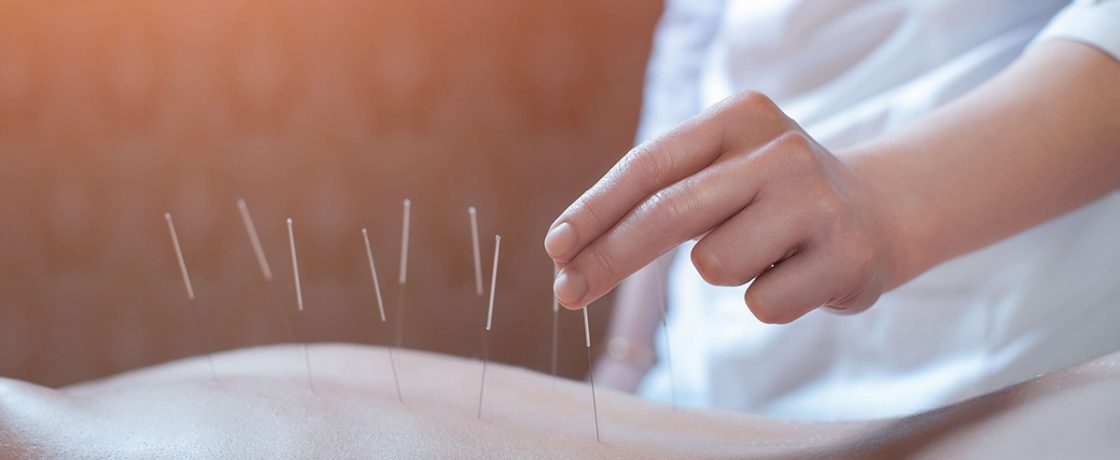 miscnceptions about acupuncture