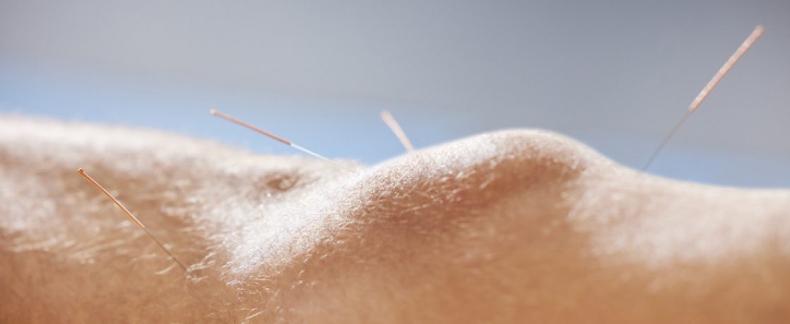 Acupuncture Needles in A Knee for Arthritis Treatment