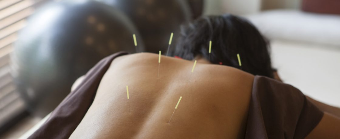 female gets acupuncture treatment